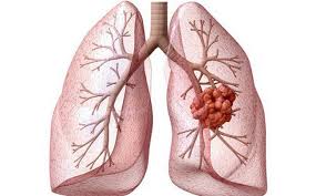 Câu hỏi về ung thư phổi