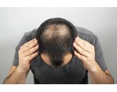 Dấu hiệu & triệu chứng rụng tóc