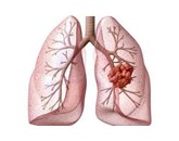 Làm thế nào để ngăn ngừa ung thư phổi