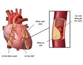 Phòng ngừa và điều trị cơn đau tim