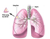 Ung thư phổi