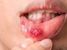 Viêm miệng là gì?