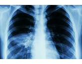 Viêm phổi, Nguyên nhân và triệu chứng