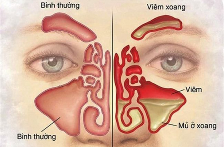 Viêm xoang, Nguyên nhân và Triệu chứng